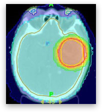 転移性脳腫瘍のCT撮影